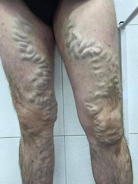 запоставени машки проширени вени