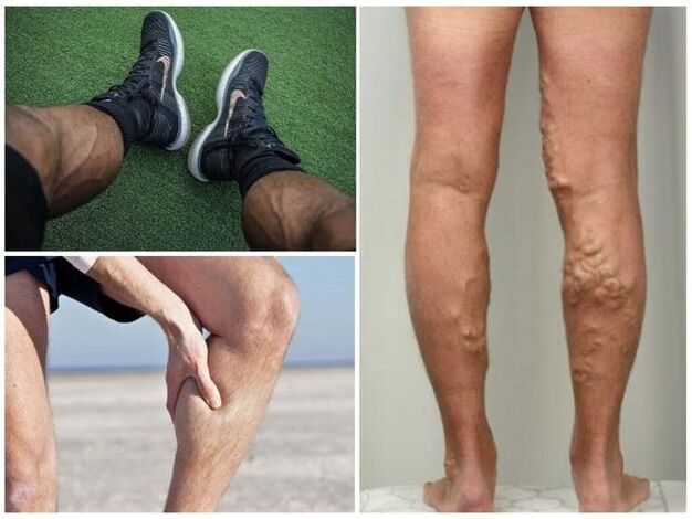како изгледаат проширените вени на машките нозе