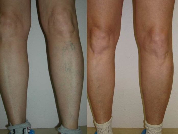нозете пред и по ласерски третман на проширени вени