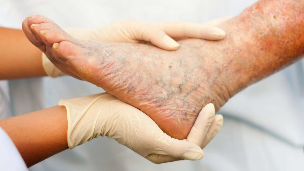 Флебологот се занимава со третман на проширени вени на нозете
